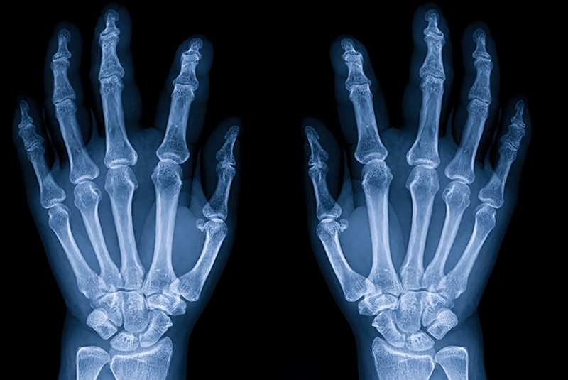 Hands-X-Ray